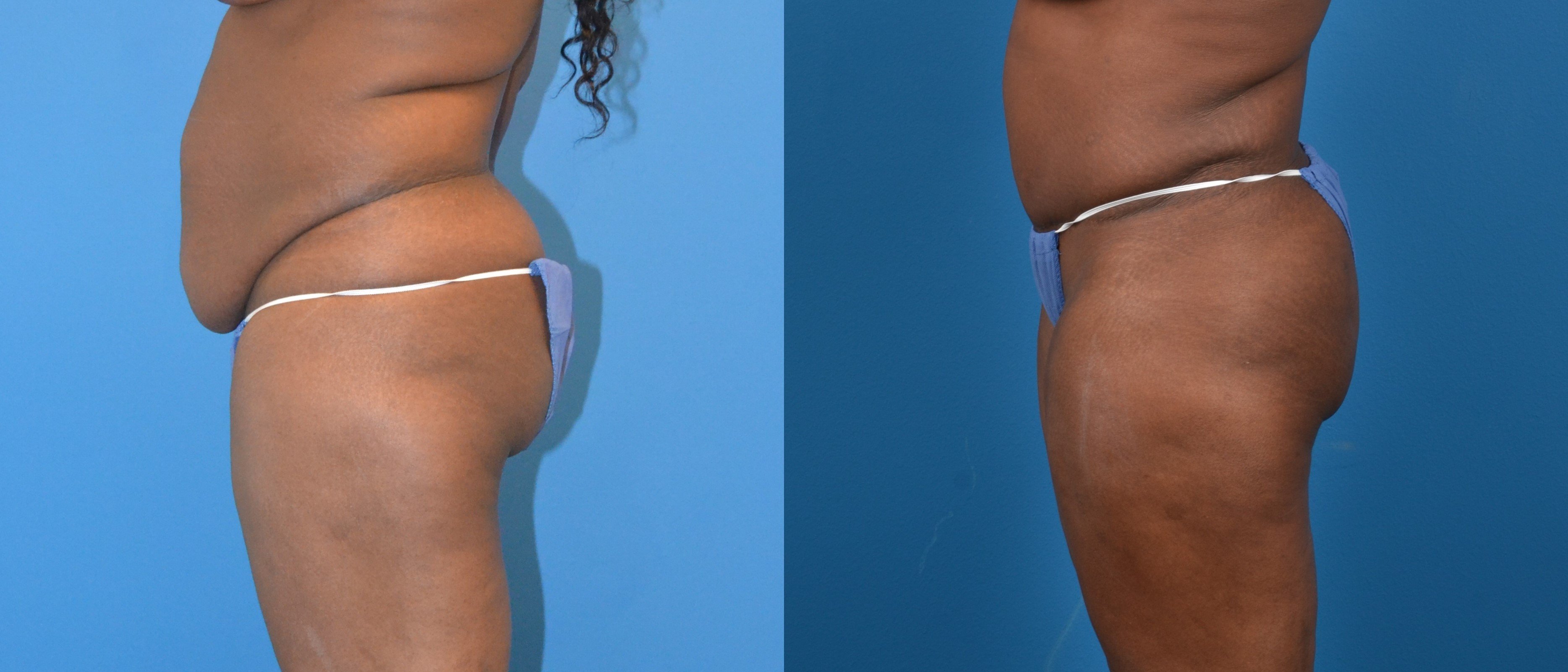 Hidden Liposuction  Before & After Gallery - Patient 197789 - Image 2