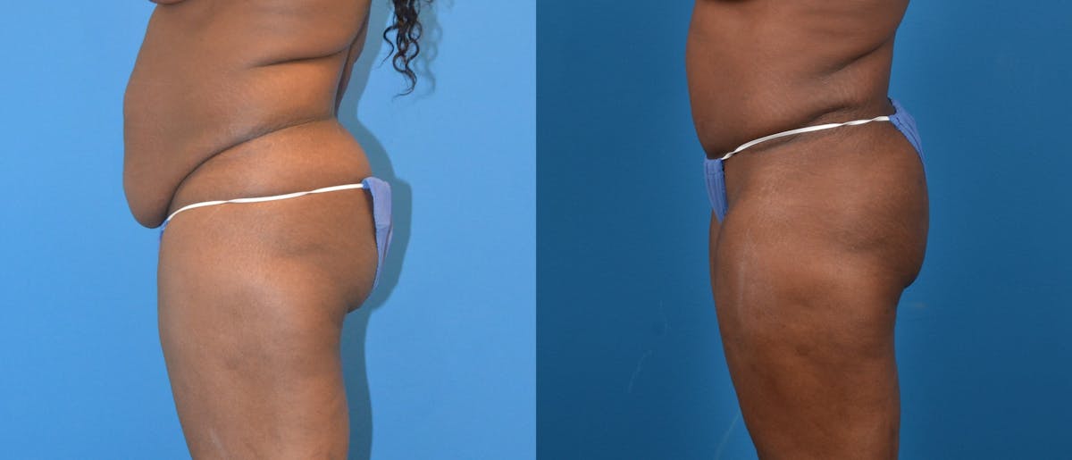 Liposuction Before & After Gallery - Patient 427888 - Image 2