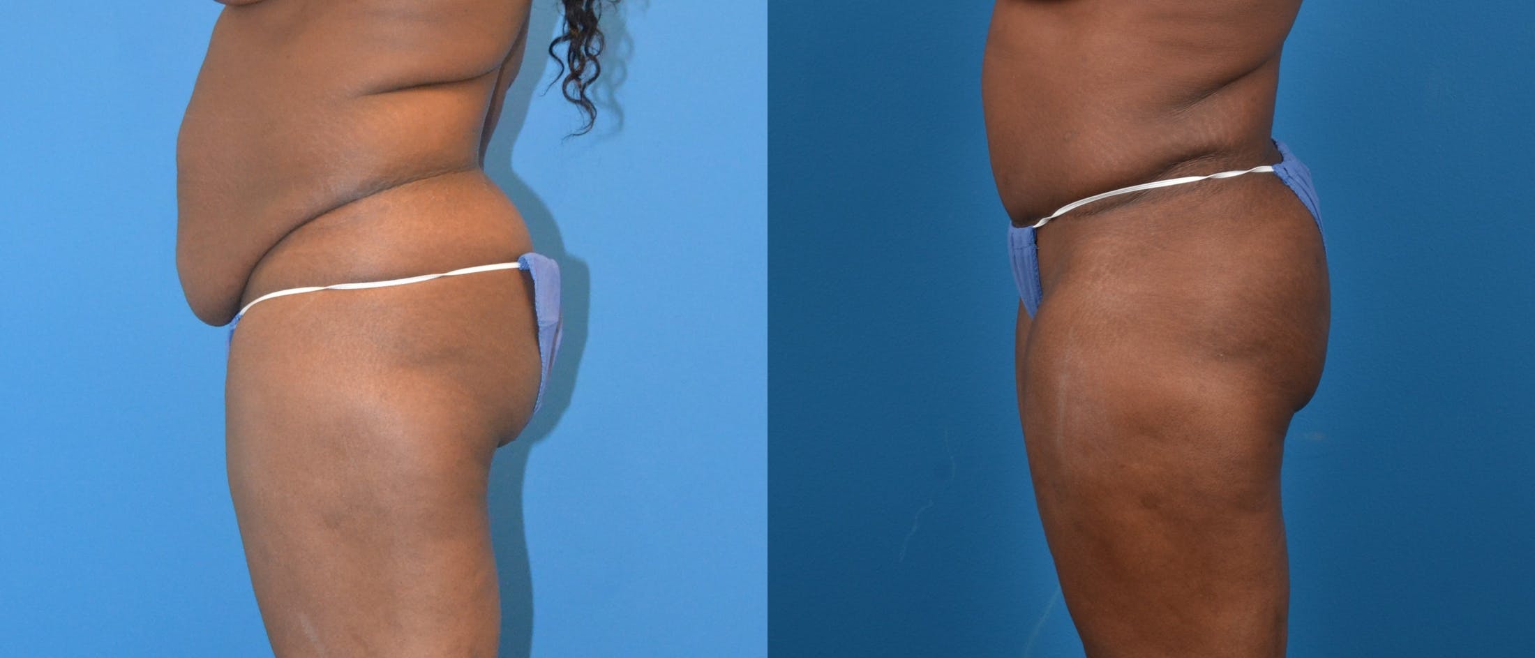 Liponique Body Contouring Before & After Gallery - Patient 122406038 - Image 2