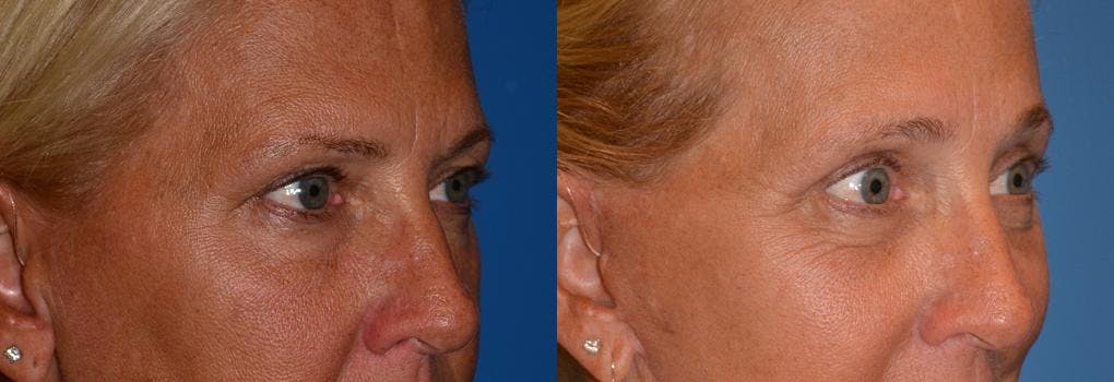 Eyelid Surgery Before & After Gallery - Patient 122406037 - Image 2