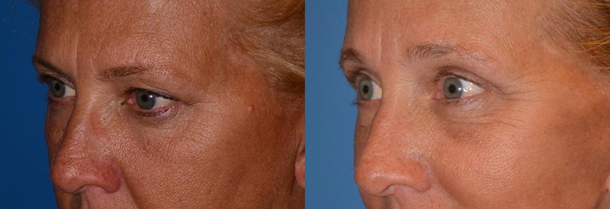 Eyelid Surgery Before & After Gallery - Patient 122406037 - Image 3