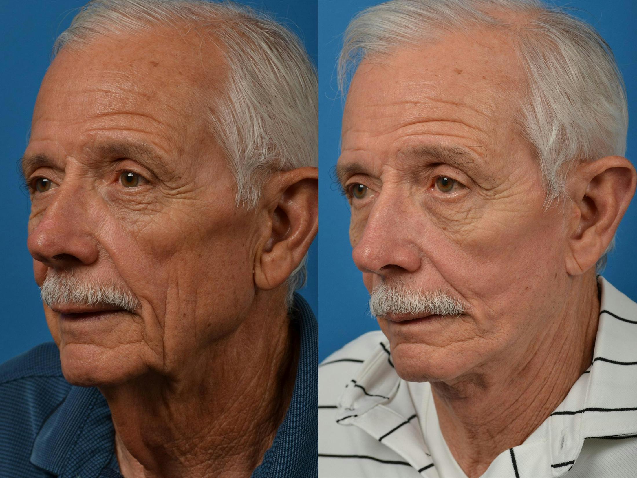 Facelift Before & After Gallery - Patient 122406041 - Image 3