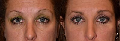 Eyelid Surgery Before & After Gallery - Patient 122406040 - Image 1