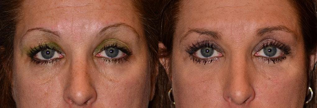 Eyelid Surgery Before & After Gallery - Patient 122406040 - Image 1