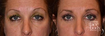 Eyelid Surgery Before & After Gallery - Patient 318564 - Image 1