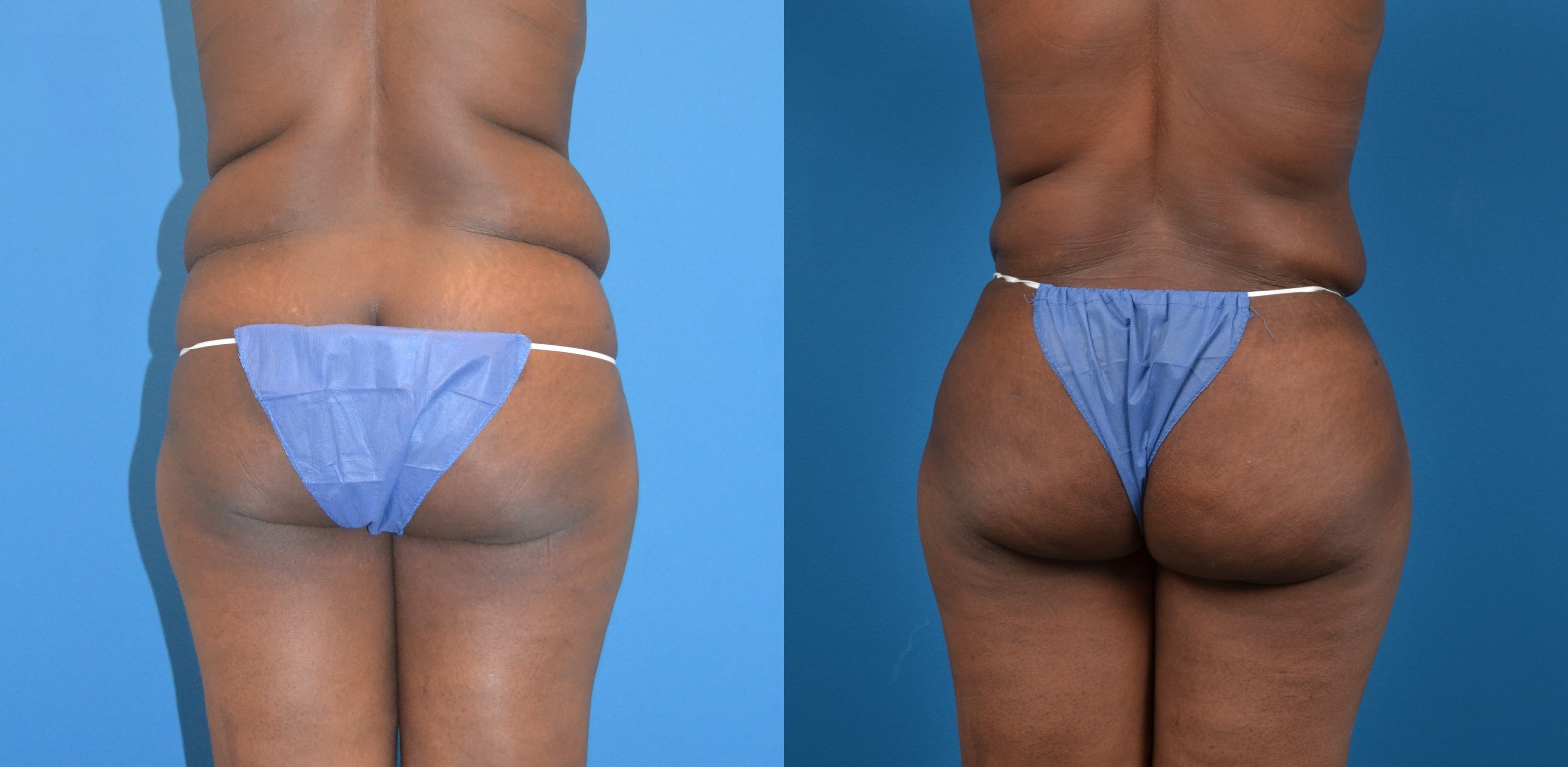 Hidden Liposuction  Before & After Gallery - Patient 197789 - Image 4
