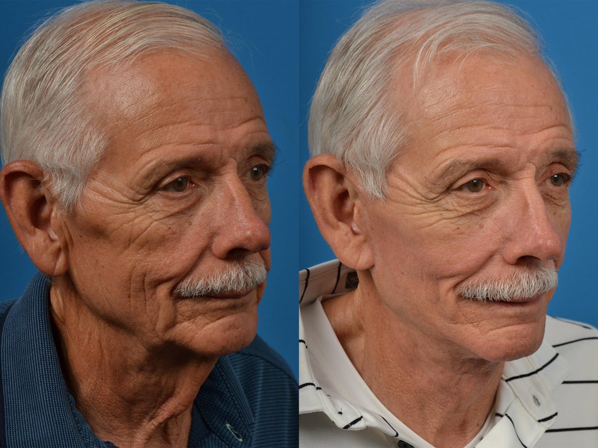 Facelift Before & After Gallery - Patient 122406041 - Image 4