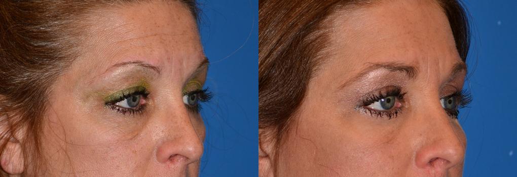 Eyelid Surgery Before & After Gallery - Patient 318564 - Image 2