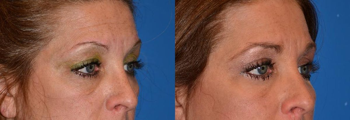 Eyelid Surgery Before & After Gallery - Patient 122406040 - Image 2