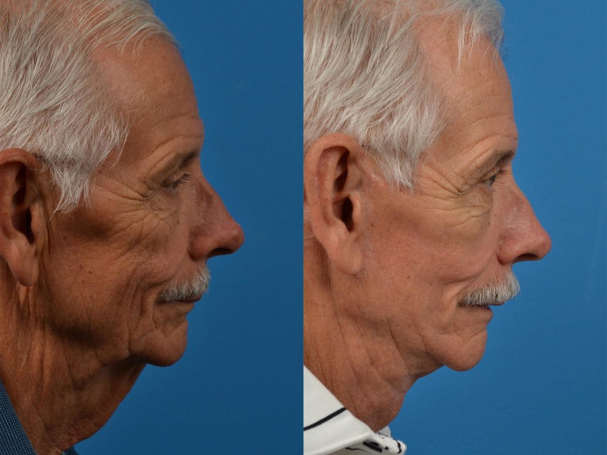 Facelift Before & After Gallery - Patient 122406041 - Image 5