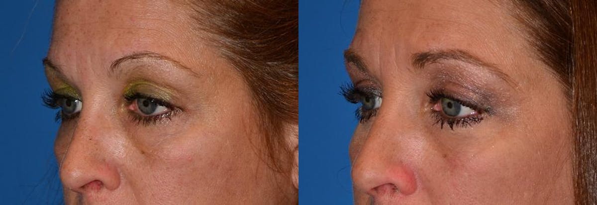 Eyelid Surgery Before & After Gallery - Patient 122406040 - Image 3