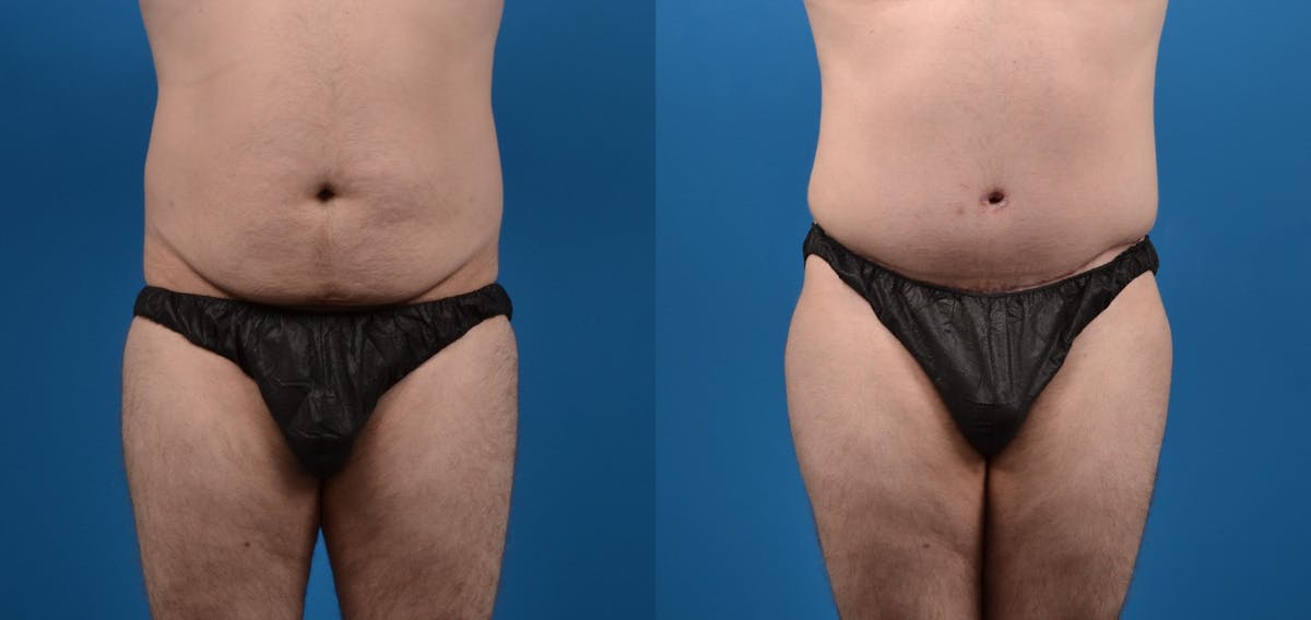 Liposuction Before & After Gallery - Patient 126500 - Image 1