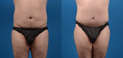 Liposuction Before & After Gallery - Patient 126500 - Image 1