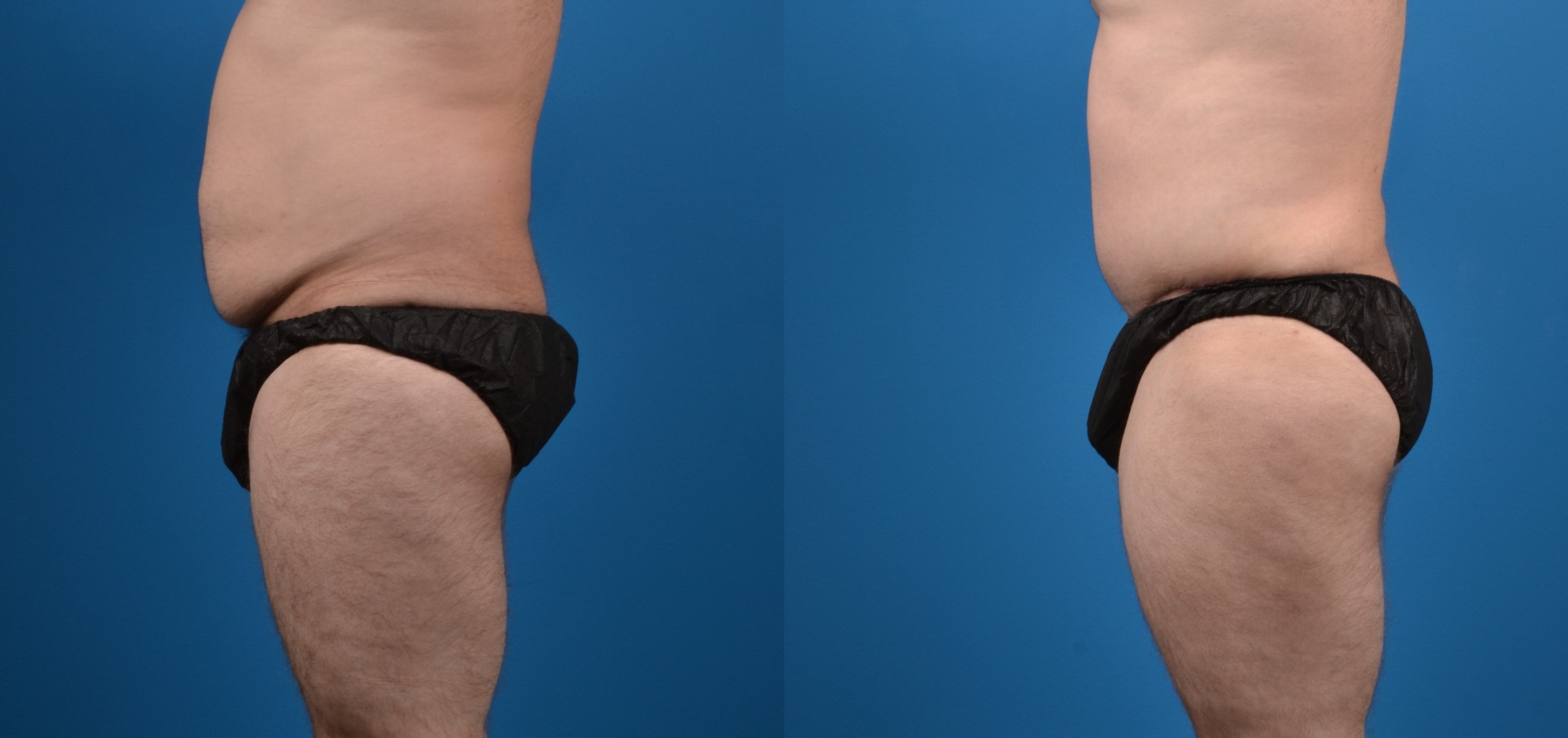 Hidden Liposuction  Before & After Gallery - Patient 301165 - Image 2