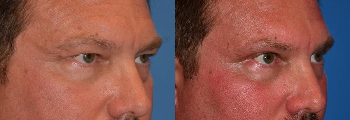 Eyelid Surgery Before & After Gallery - Patient 122406042 - Image 2