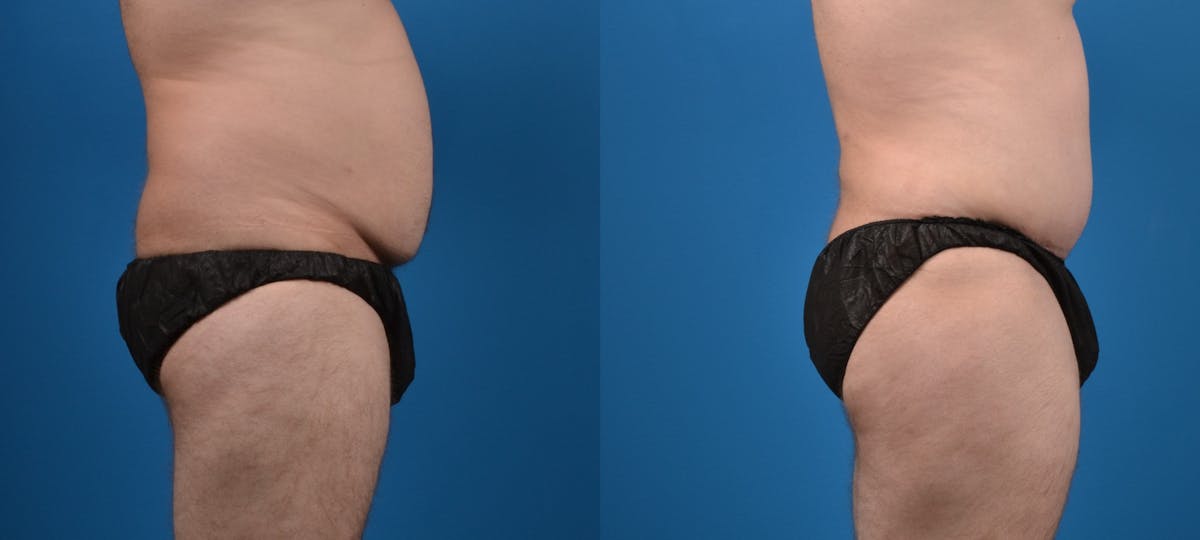 Liposuction Before & After Gallery - Patient 126500 - Image 3