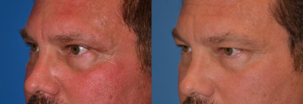 Eyelid Surgery Before & After Gallery - Patient 122406042 - Image 3