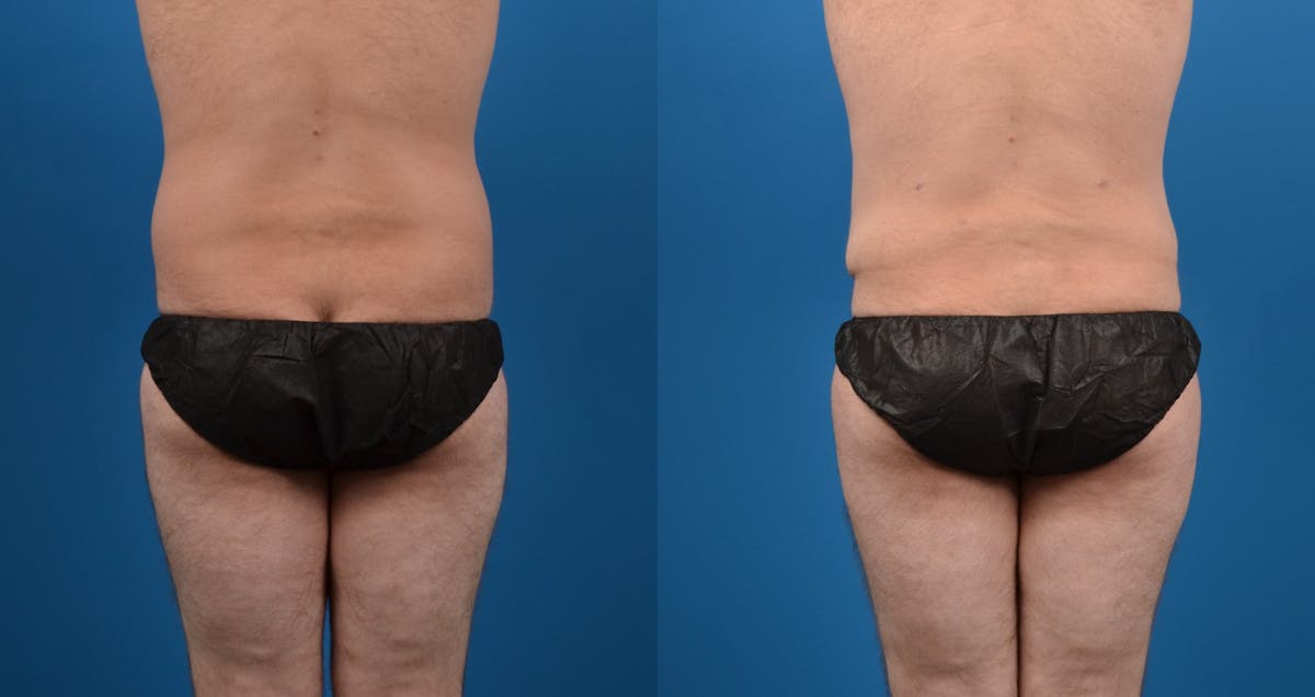 Liposuction Before & After Gallery - Patient 126500 - Image 4