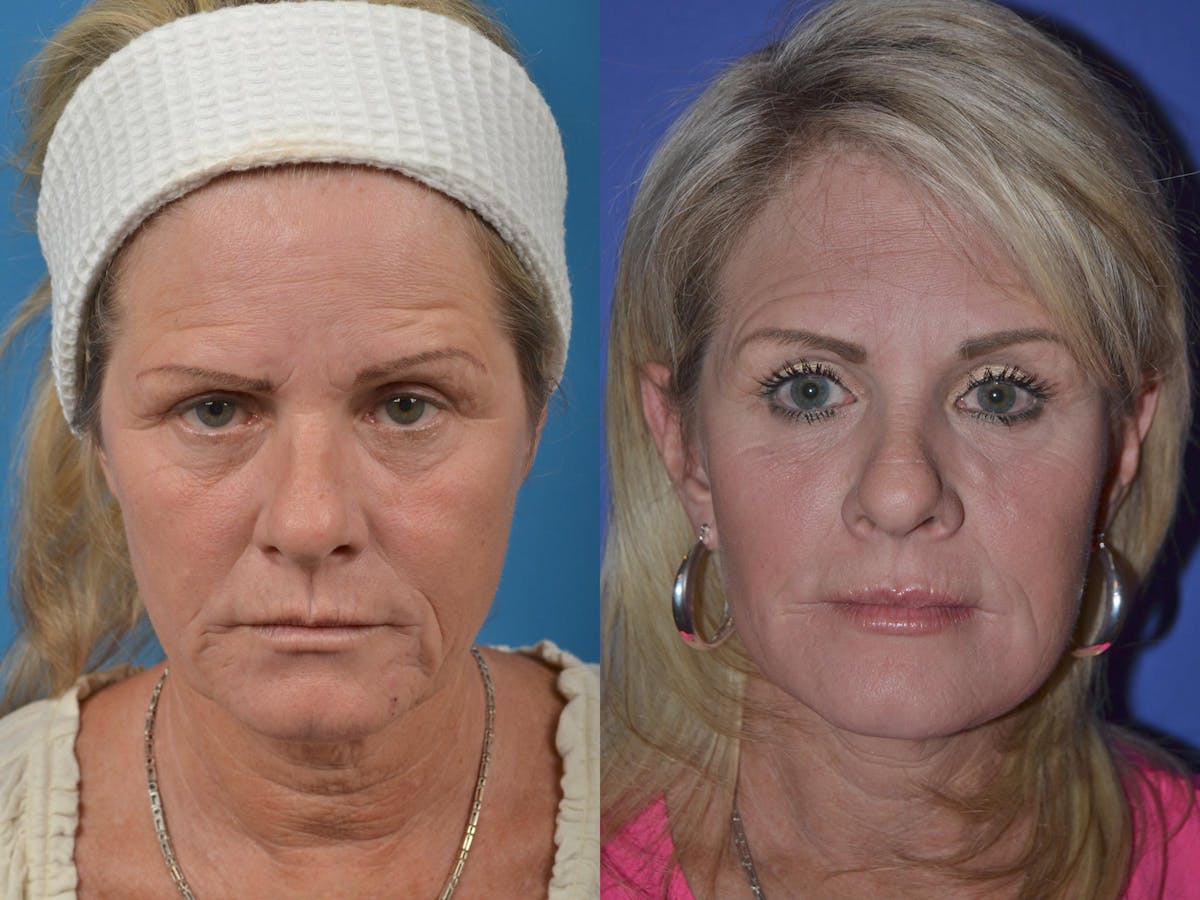 Facelift Before & After Gallery - Patient 122406046 - Image 1