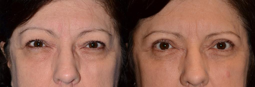 Eyelid Surgery Before & After Gallery - Patient 100554 - Image 1