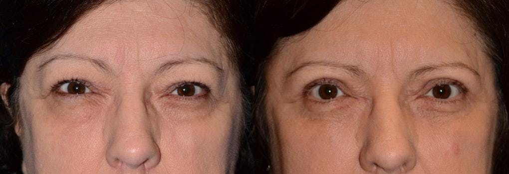 Eyelid Surgery Before & After Gallery - Patient 122406044 - Image 1