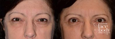 Eyelid Surgery Before & After Gallery - Patient 100554 - Image 1