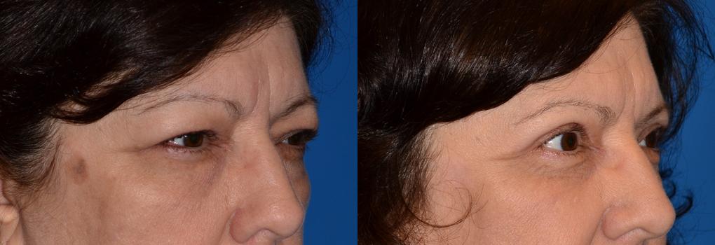 Eyelid Surgery Before & After Gallery - Patient 100554 - Image 2