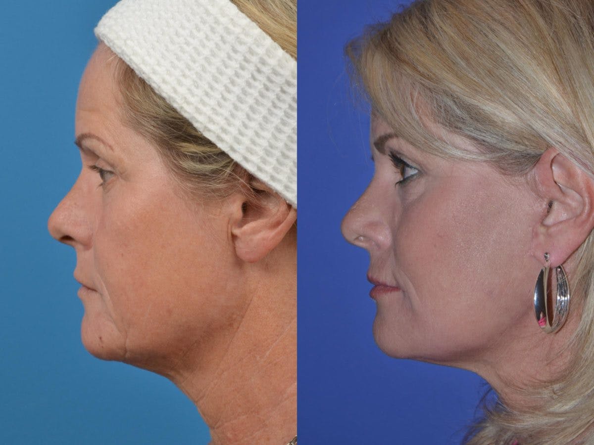 Facelift Before & After Gallery - Patient 122406046 - Image 2