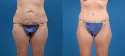 Liposuction Before & After Gallery - Patient 258868 - Image 1