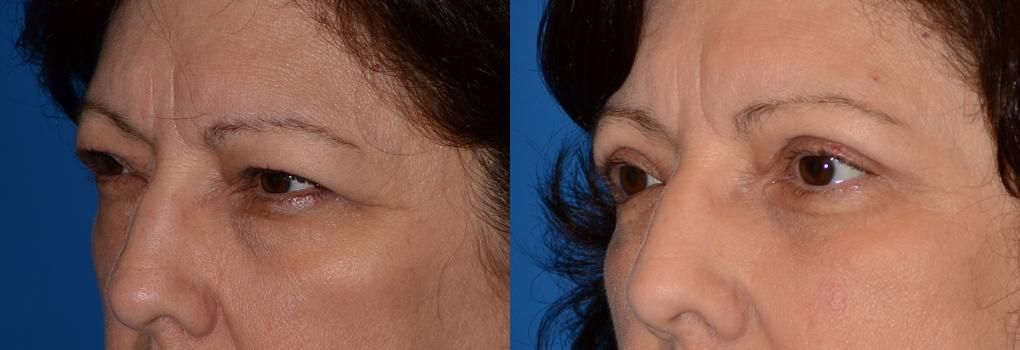 Eyelid Surgery Before & After Gallery - Patient 100554 - Image 3