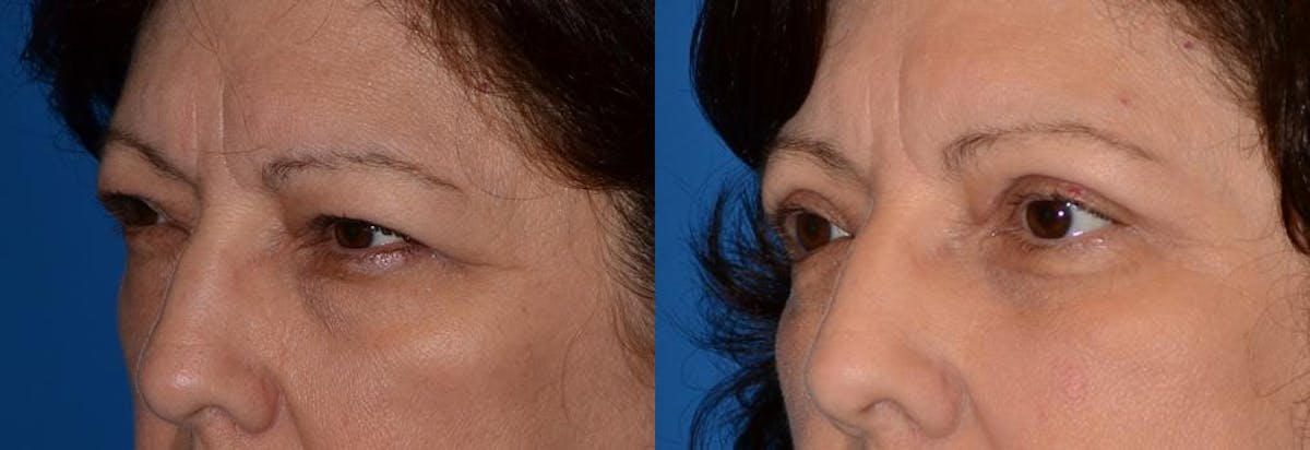 Eyelid Surgery Before & After Gallery - Patient 122406044 - Image 3