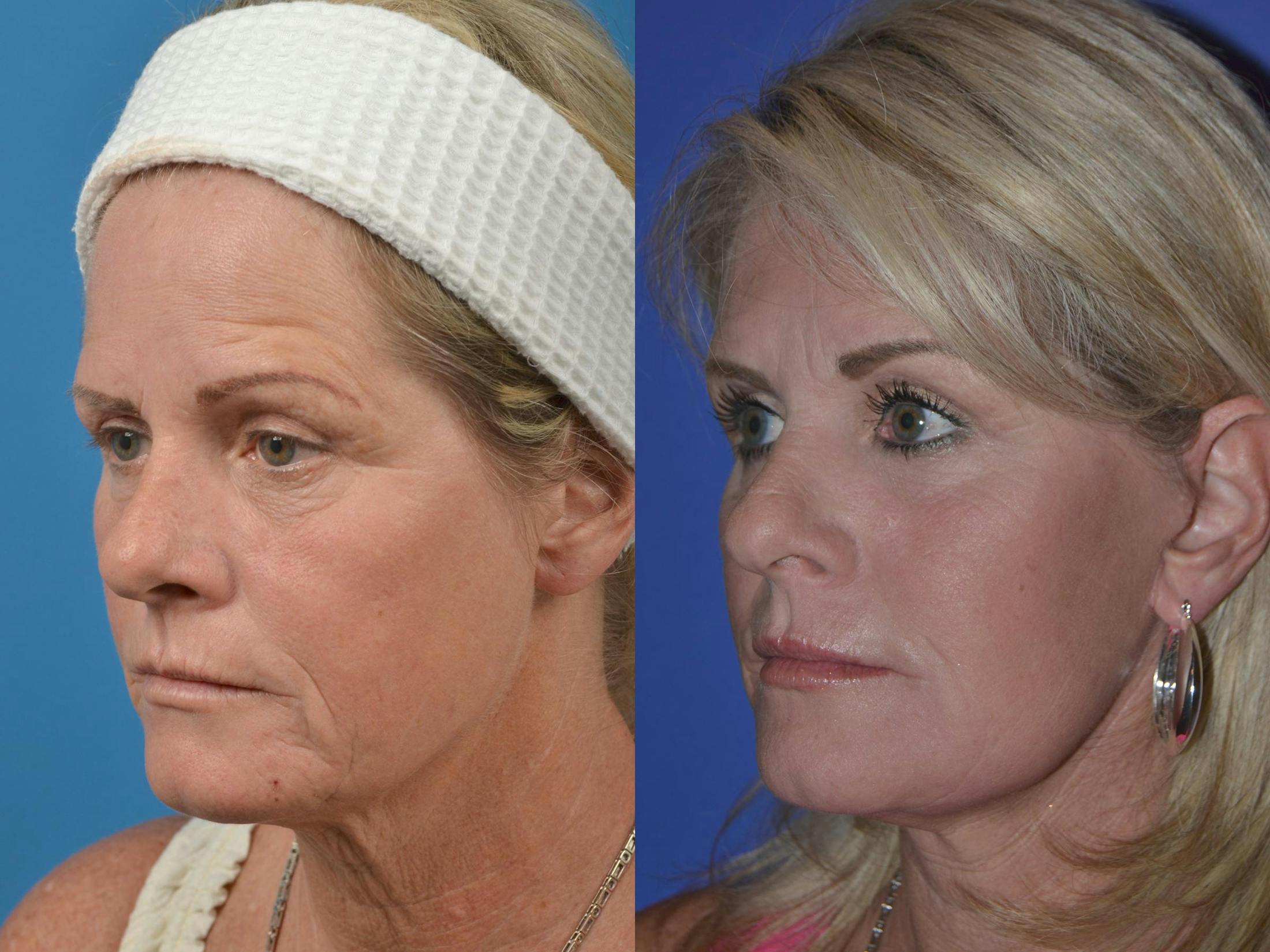 Facelift Before & After Gallery - Patient 122406046 - Image 3
