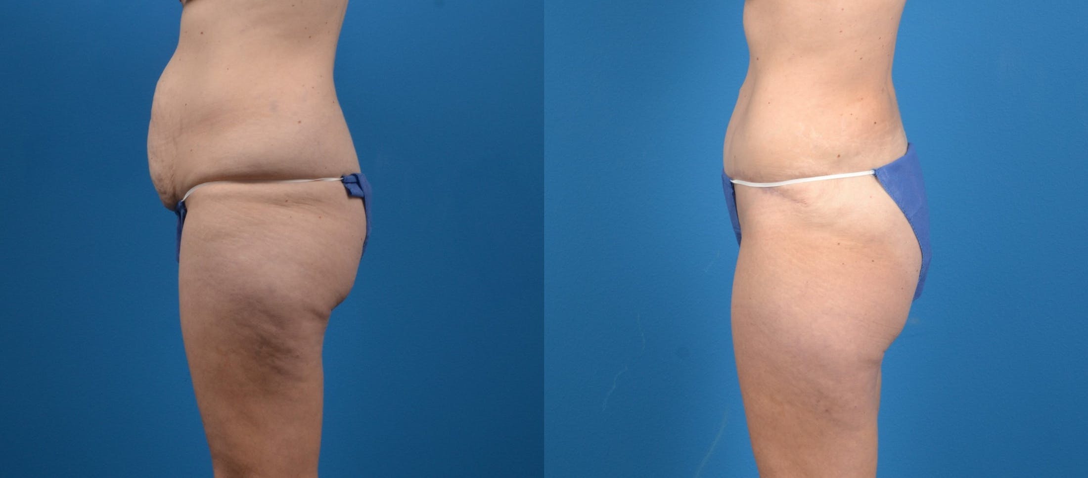 Liponique Body Contouring Before & After Gallery - Patient 122406047 - Image 2