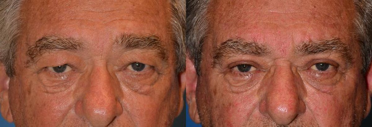 Eyelid Surgery Before & After Gallery - Patient 122406045 - Image 1