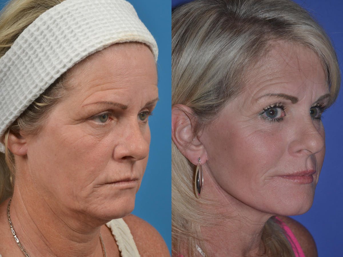 Facelift Before & After Gallery - Patient 122406046 - Image 4