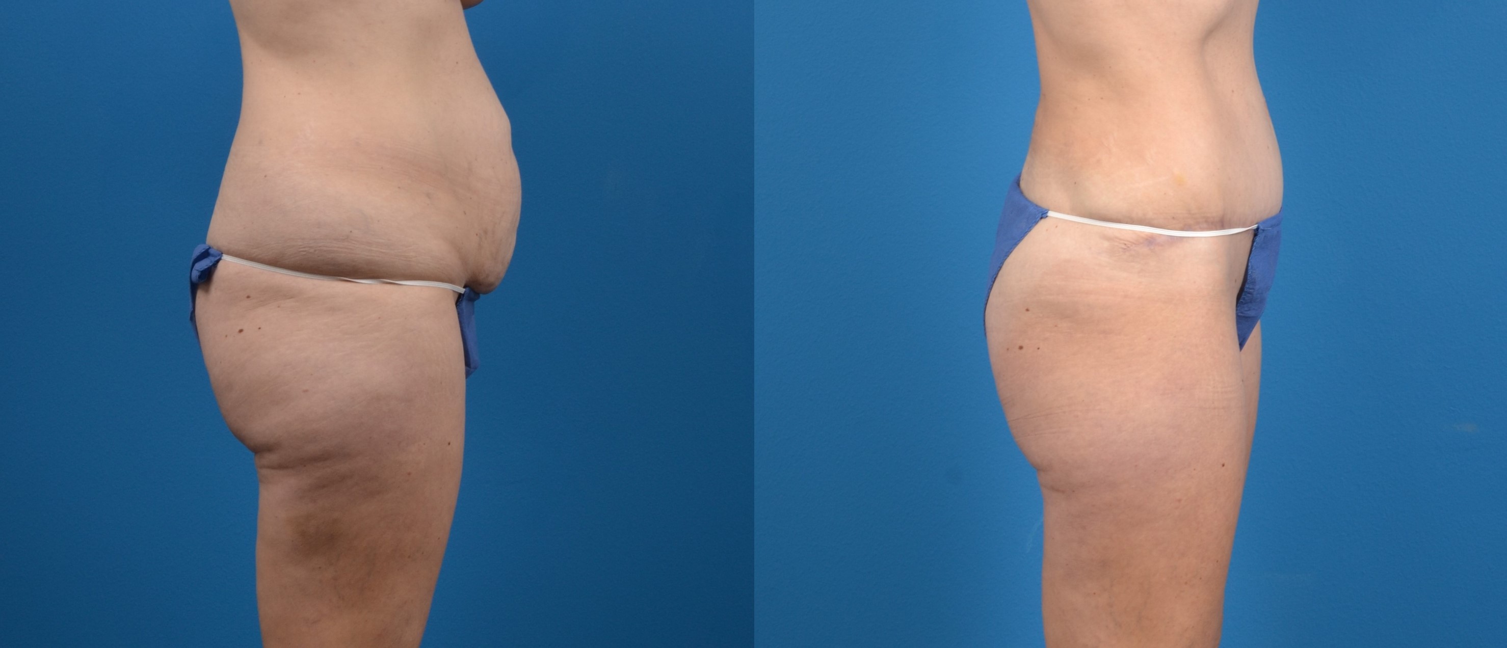Hidden Liposuction  Before & After Gallery - Patient 363310 - Image 3
