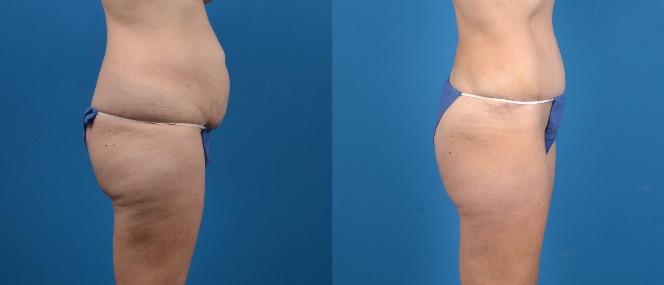 Liponique Body Contouring Before & After Gallery - Patient 122406047 - Image 3