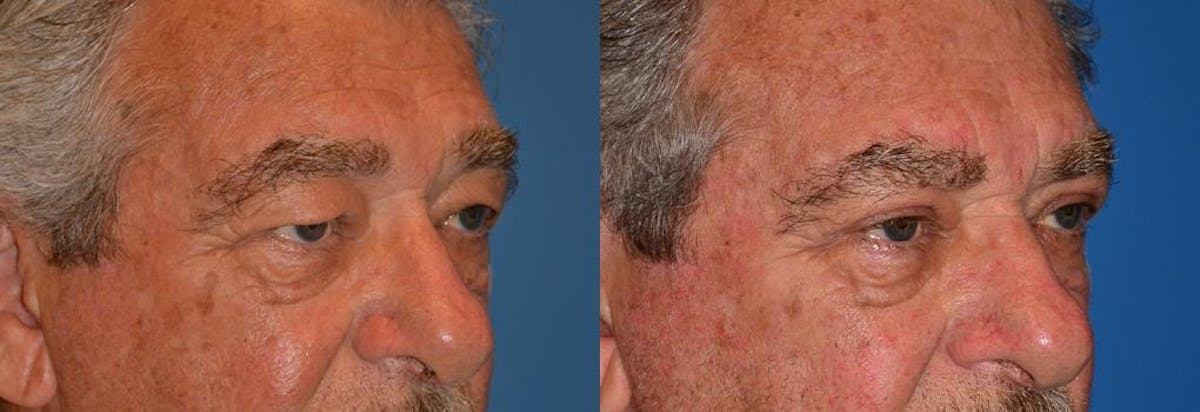 Eyelid Surgery Before & After Gallery - Patient 122406045 - Image 2