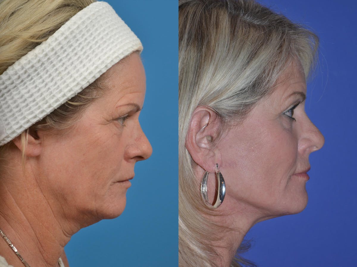 Facelift Before & After Gallery - Patient 122406046 - Image 5