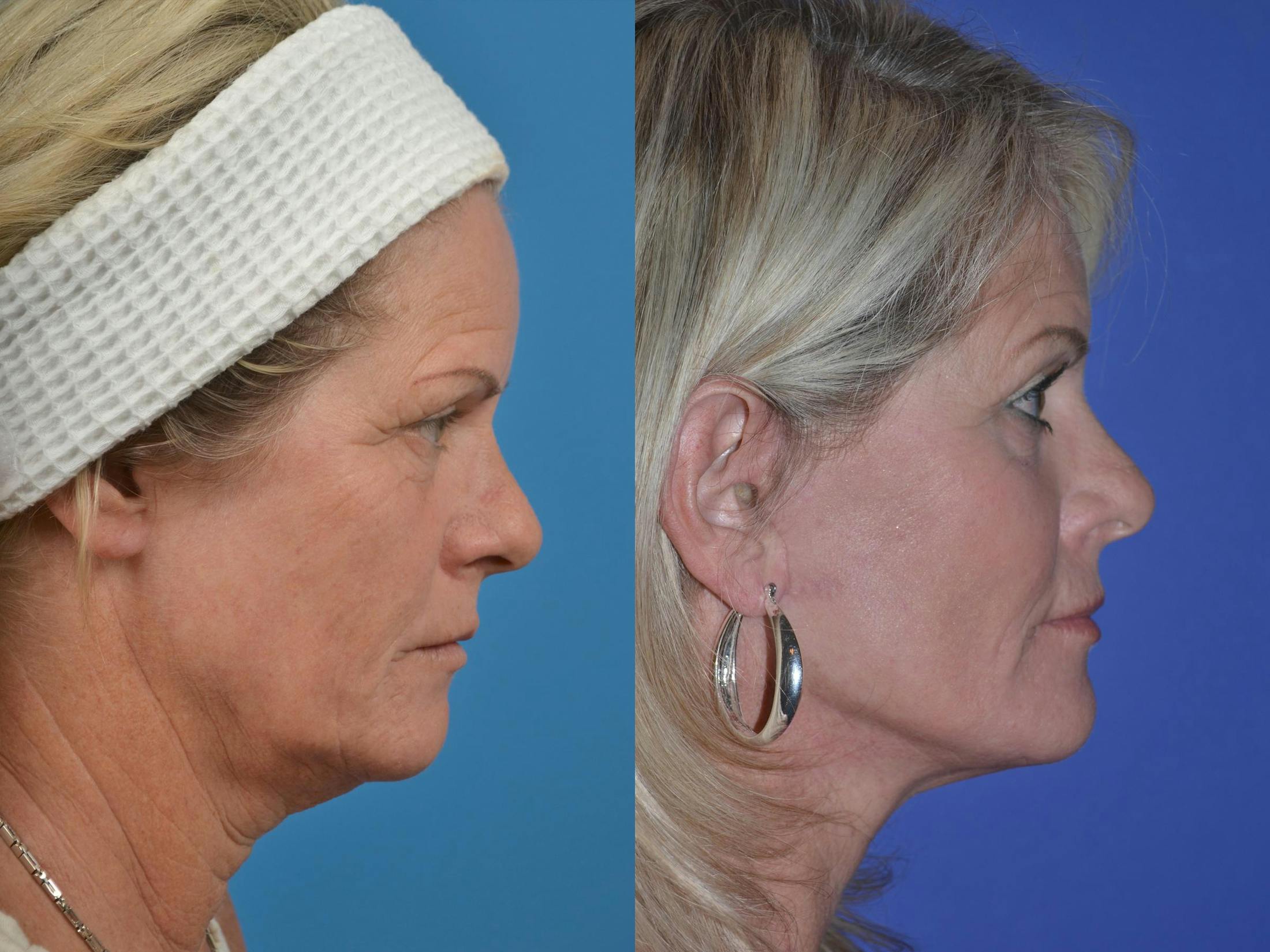 Facelift Before & After Gallery - Patient 122406046 - Image 5