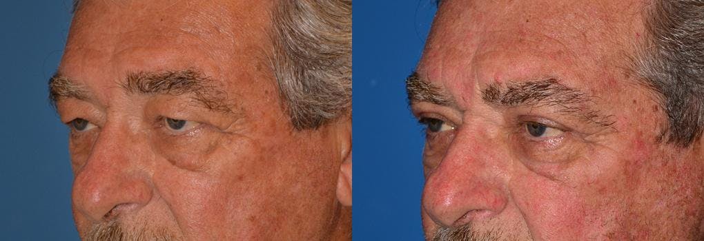 Eyelid Surgery Before & After Gallery - Patient 122406045 - Image 3