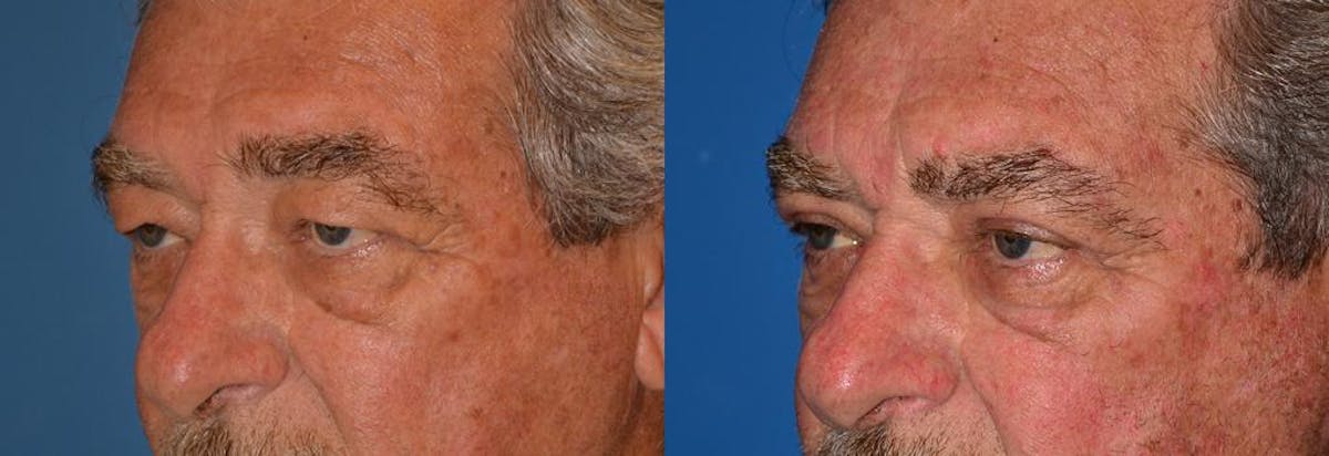 Eyelid Surgery Before & After Gallery - Patient 122406045 - Image 3