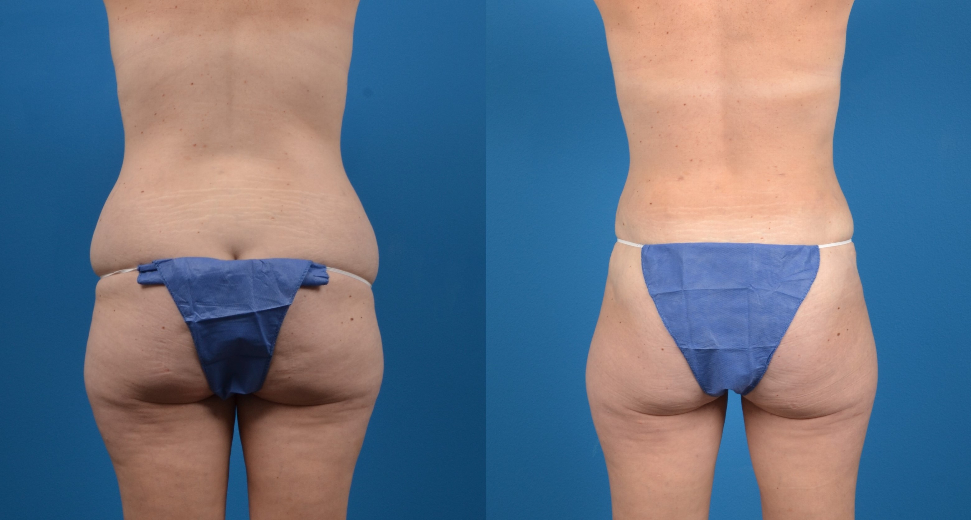 Hidden Liposuction  Before & After Gallery - Patient 363310 - Image 4