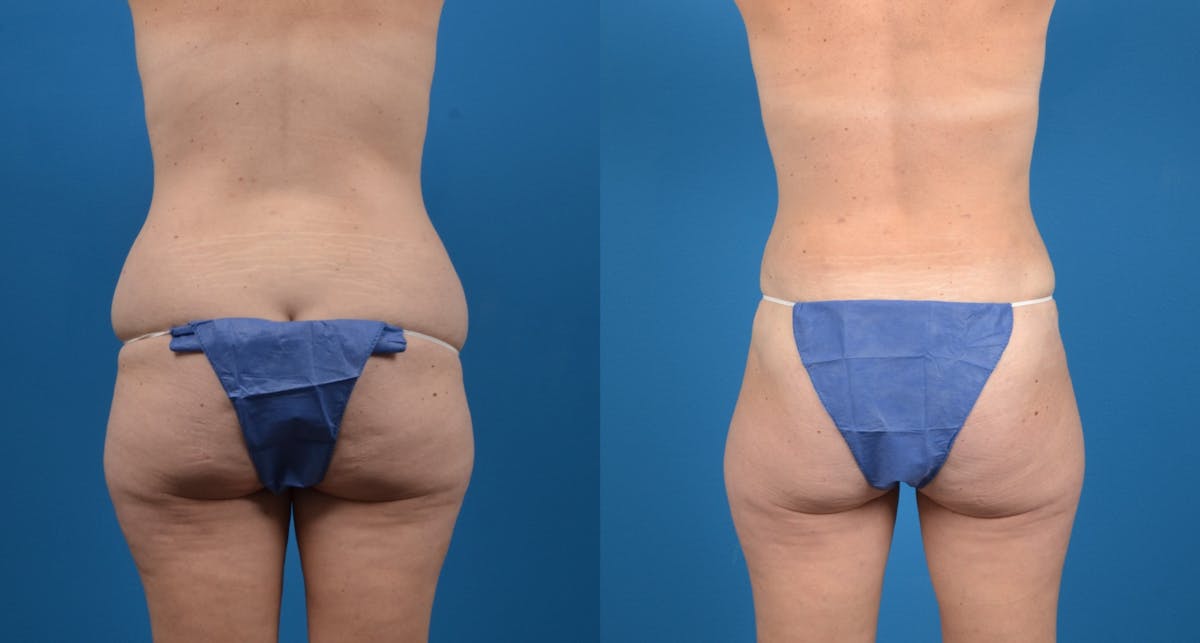 Liposuction Before & After Gallery - Patient 258868 - Image 4