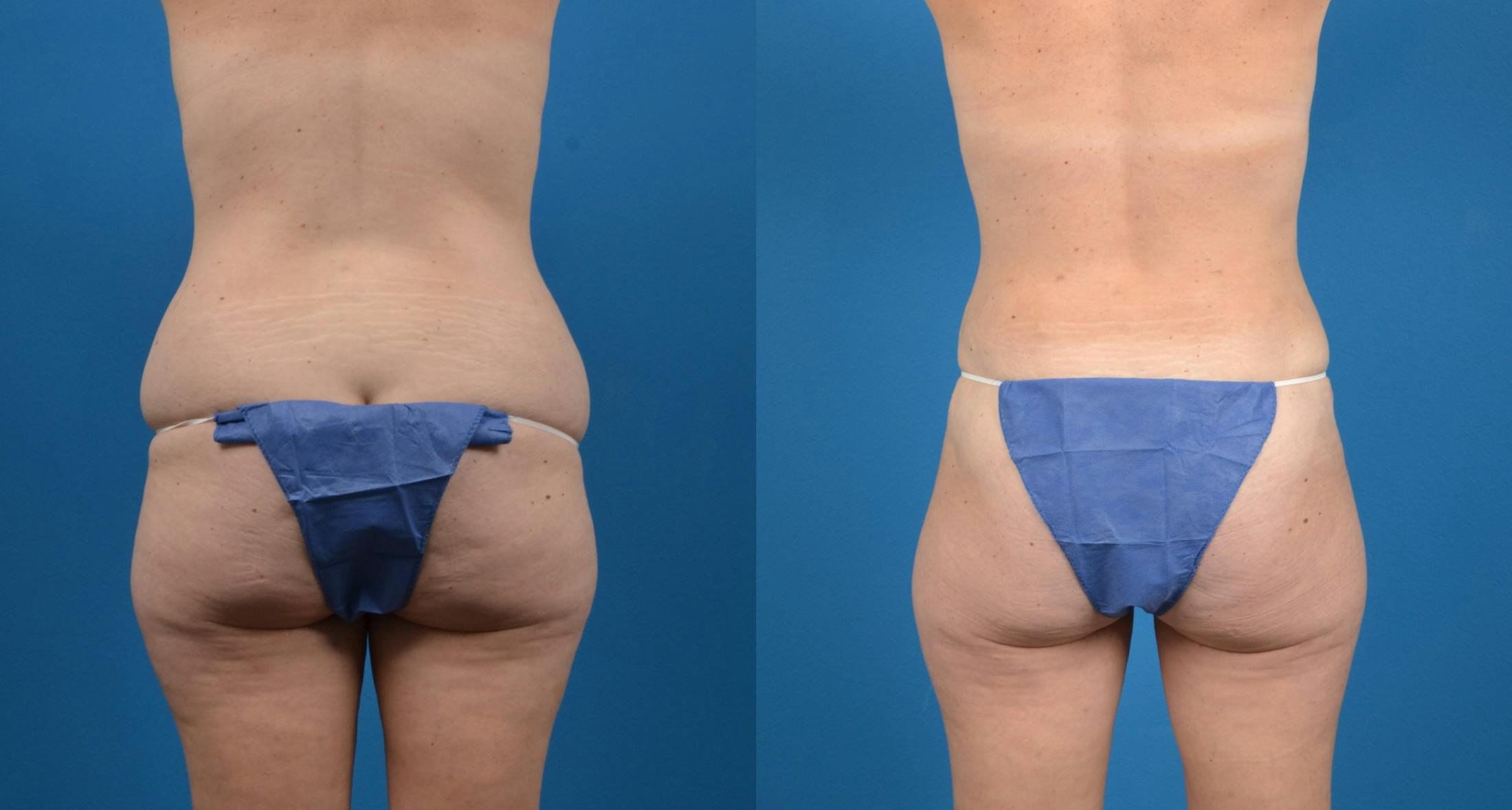 Liponique Body Contouring Before & After Gallery - Patient 122406047 - Image 4