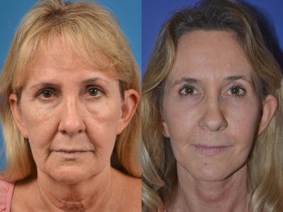 Facelift Before & After Gallery - Patient 122406051 - Image 1