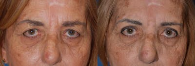 Eyelid Surgery Before & After Gallery - Patient 122406049 - Image 1