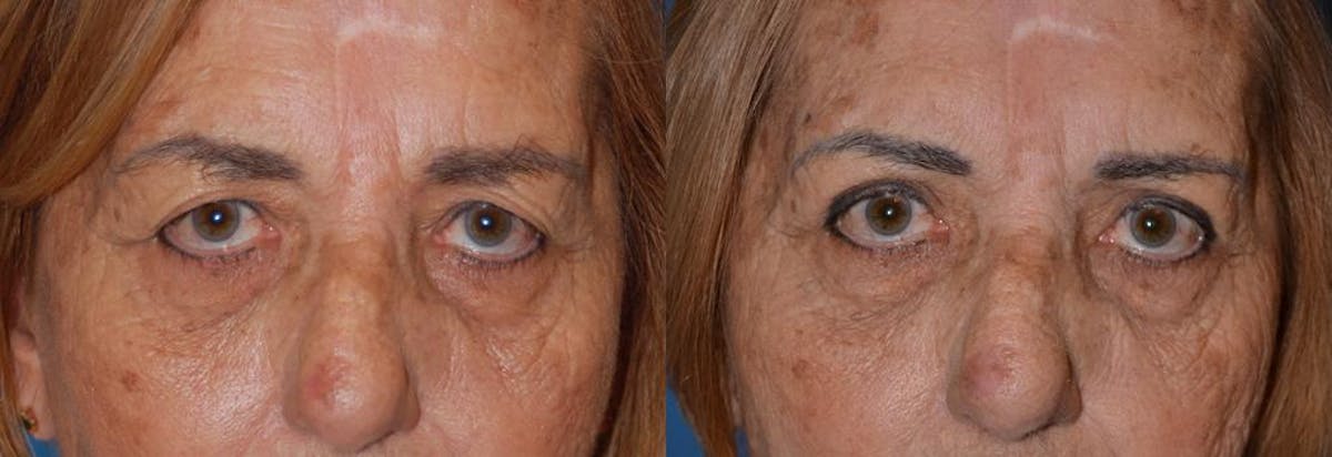 Eyelid Surgery Before & After Gallery - Patient 122406049 - Image 1