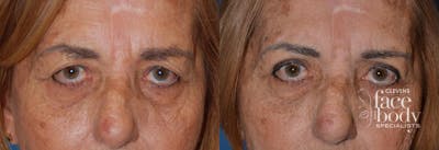 Eyelid Surgery Before & After Gallery - Patient 161777 - Image 1