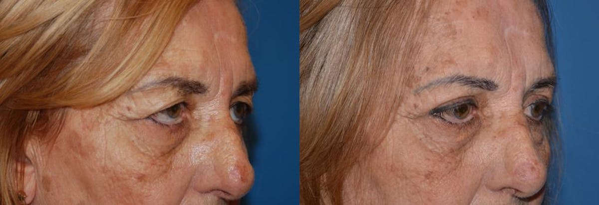 Eyelid Surgery Before & After Gallery - Patient 122406049 - Image 2